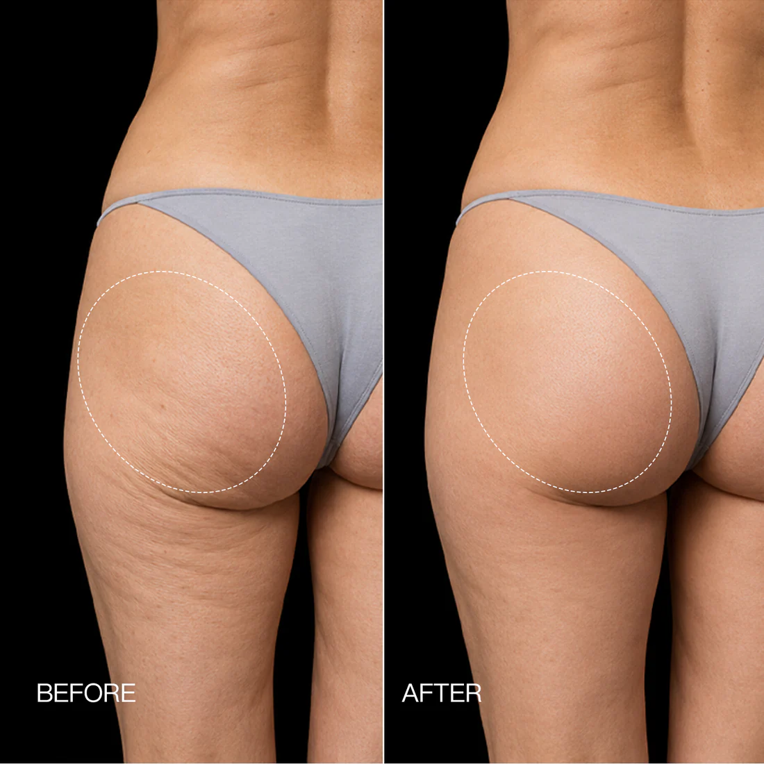 3-Zone EMS Toning Shorts: Targeted Abdomen, Glutes & Pelvic Floor Support