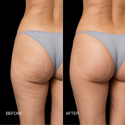 3-Zone EMS Toning Shorts: Targeted Abdomen, Glutes & Pelvic Floor Support