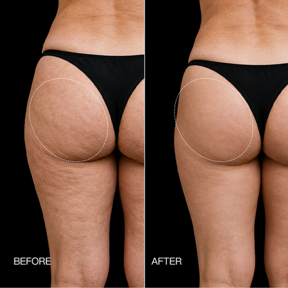 3-Zone EMS Toning Shorts: Targeted Abdomen, Glutes & Pelvic Floor Support